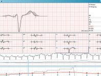Screen der PADSY-Software Belastungs-EKG