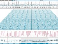 Screen der PADSY-Software Langzeit-EKG - räumlich