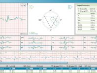 Screen der PADSY-Software Ruhe-EKG